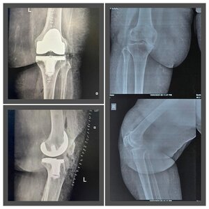 Pre and post xray of Total Knee Replacement Surgery