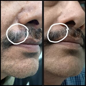 Case of alopecia areata patchy balding on moustache, post treatment showing regrowth of hair - Dr. Vallari Soman