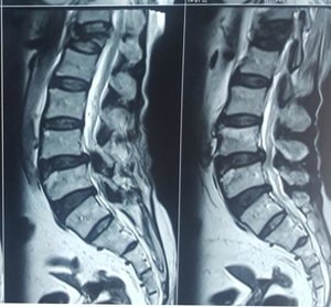f Osteoporotic Vertebral Compression Fracture pre-operative - Dr. Ajay Kothari - Spine Surgeon | Shivaji Nagar, Pune