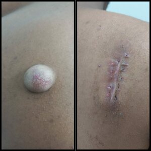 Keratinous Cyst Excision