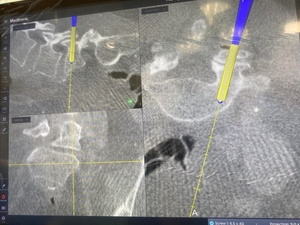 Formal launch of O Arm and Navigation the Robotic technology for Spine Surgery - Dr. Ajay Kothari - Spine Surgeon | Shivaji Nagar, Pune