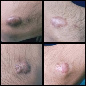Result of keloid post one session of laser
