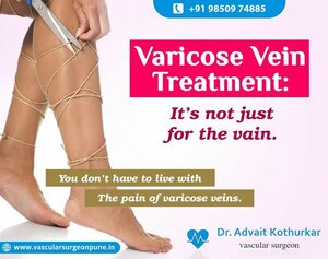 Varicose Veins
