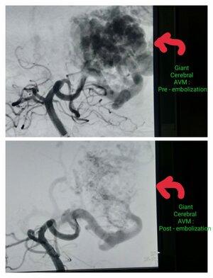 Photo : Pre procedure- Giant cerebral AVM Pre embolization &amp; Post Embolization procedure- Giant Cerebral AVM Post embolisation.