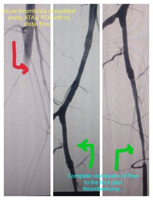 Photo : Thrombectomy - Pre &amp; Post