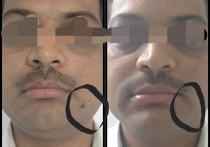 Patient post mole removal