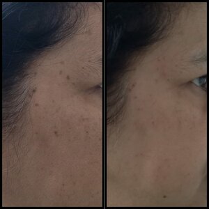 Mole removal immediately Before and After