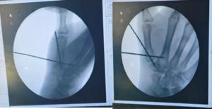 Bennett Fracture Surgery