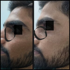 24 year old male patient having milia around eyes removed via Electrocautery. Result immediately post procedure