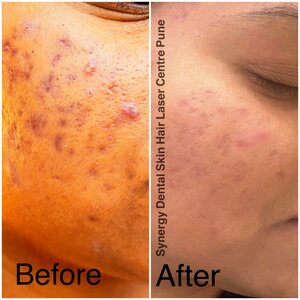 Before After Results