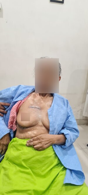 MICS-AVR for 82 yrs old lady