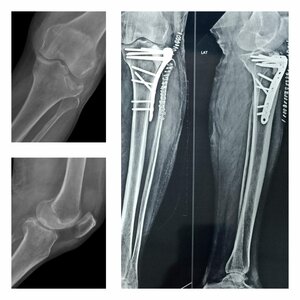 Tibia Fracture X-rays