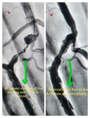 Photo : Dialysis AV Fistula procedure - Pre Procedure &amp; Post Procedure