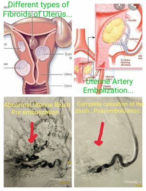 Photo : Uterine Artery Embolization
