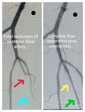 Photo : Posterior Tibial Artery Stenting