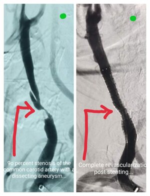 Photo : Carotid Artery Stenting Procedure Pre procedure - 95% stenosis in Internal Carotid Artery Post Procedure- Deploy Stent &amp; restore complete blood flow