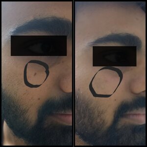 Wart removal Before and After