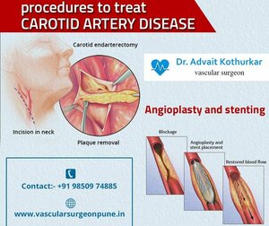 Procedures to treat Carotid Artery Disease