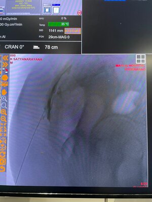 Epidural Steroid Injection