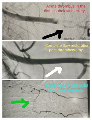 Photo : Thrombectomy - Pre &amp; Post