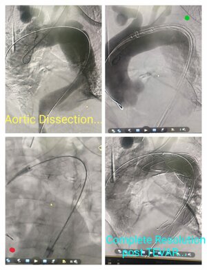 Photo : Thoracic endovascular aortic repair procedure (TEVAR)