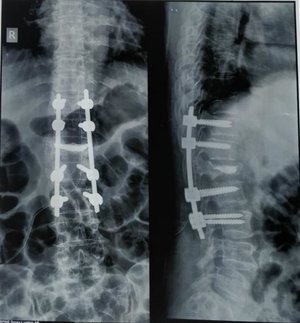 f Osteoporotic Vertebral Compression Fracture post-operative - Dr. Ajay Kothari - Spine Surgeon | Shivaji Nagar, Pune