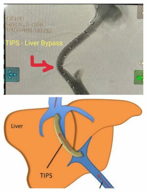 Photo : Transjugular Intrahepatic portosystemic shunt ( TIPS Procedure) for Liver