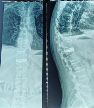 Vertebroplasty Surgery