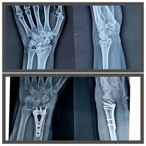 Pre and post xray of fracture distal end radius