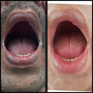 Patient having Oral Thrush ( candidiasis) post treatment