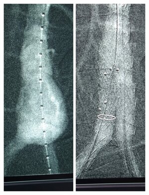 Photo : Aortic Aneurysm Repair
