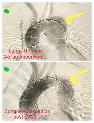 Photo : Thoracic Aortic Aneurysm