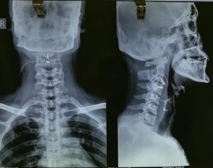 Cervical Spine Surgery post-op XRAY - Dr. Ajay Kothari - Spine Surgeon | Shivaji Nagar, Pune