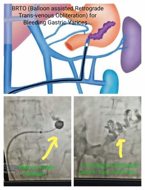 Photo : Balloon assisted retrograde Trans- Venous Obliteration for Bleeding Gastric Varices