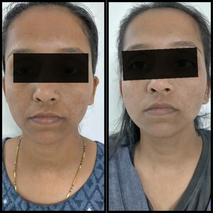 Patient after 1 session of peel for skin lightening - Dr. Vallari Soman