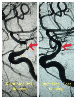 Photo : Cerebral Artery Stenting