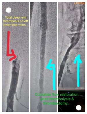Photo : Deep Vein Thrombosis (DVT) in left leg. Pre Procedure - No Flow &amp; Post Procedure- Complete flow restoration post thrombolysis &amp; Thrombectomy.