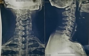 Cervical Spine Surgery pre-op XRAY - Dr. Ajay Kothari - Spine Surgeon | Shivaji Nagar, Pune