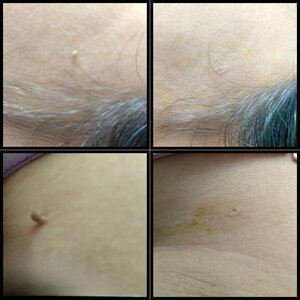 Acrochordone removal