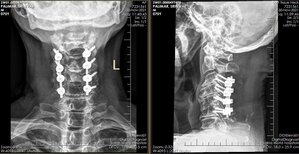 Cervical Laminectomy &amp; lateral Mass Fusion