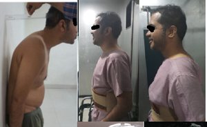 Spinal Deformity Correction per and post operative - Dr. Ajay Kothari - Spine Surgeon | Shivaji Nagar, Pune