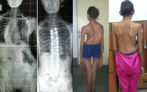 Spinal Deformity Correction pre- post operation - Dr. Ajay Kothari - Spine Surgeon | Shivaji Nagar, Pune