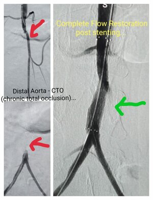 Photo : Complete total occlusion ( CTO) in Distal Aorta. Pre Procedure- No blood flow due to complete stenosis &amp; Post Procedure- Deployed Stent &amp; restore complete blood flow
