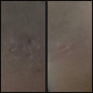 Wart removal before and immediately after session
