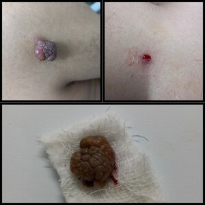 Giant acrochordone removed