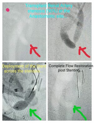 Photo : Transplant renal artery stenosis