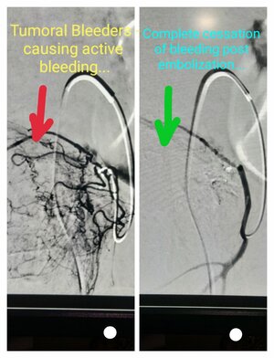 Photo : Embolisation