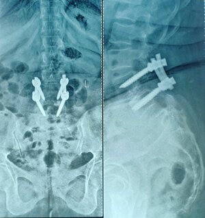 LUMBAR TLIF SURGERY