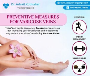 Prevention of Varicose Veins