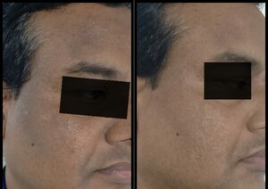 Pigment reduction after chemical peel